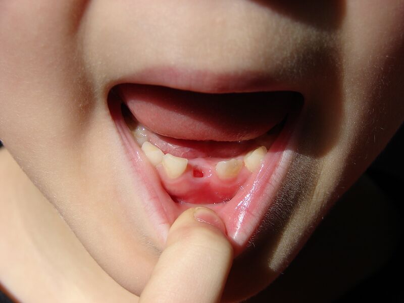 File:ToothLost-2917.jpg