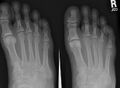 Fourth metatarsal bone