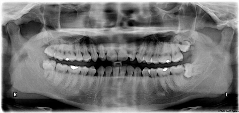 File:Impacted wisdom teeth.jpg