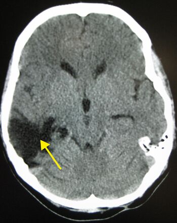 File:Traumaticbraininjury2010.jpg