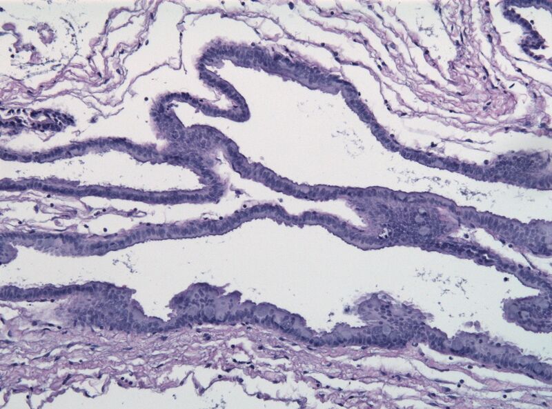File:Bronchogenic cyst.jpg