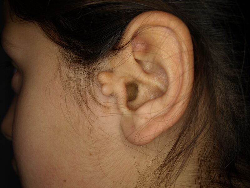 File:Accessory auricle.jpg