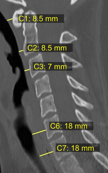 File:CT of prevertebral space.jpg
