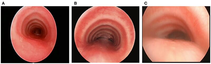 File:Tracheomalacia.jpg