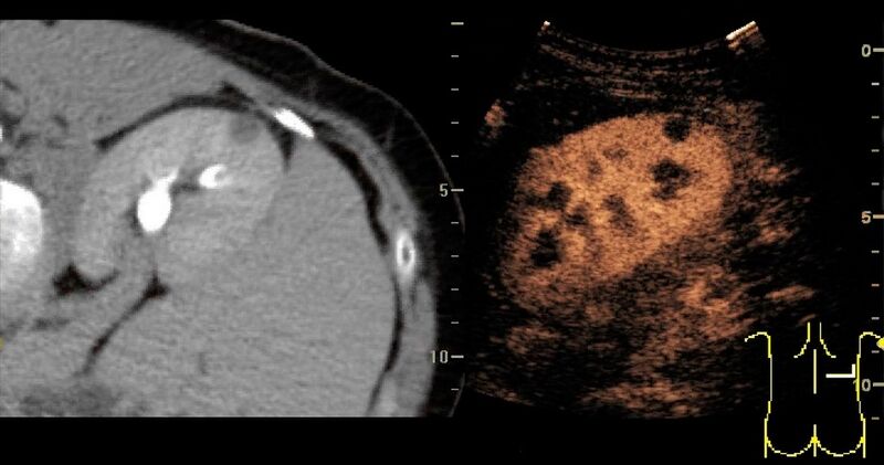 File:Contrast-enhanced ultrasonography of benign lesion.jpg