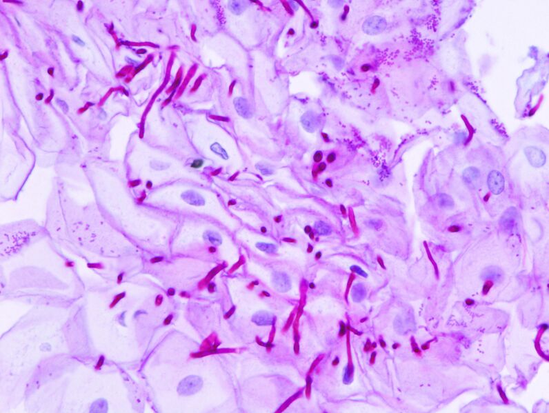 File:Esophageal candidiasis (2) PAS stain.jpg