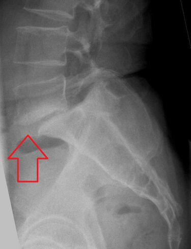 File:SpondylolisthesisL5S1.jpg