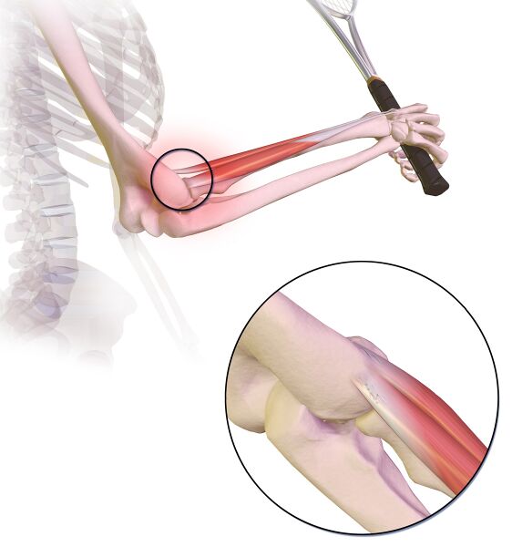 File:Tennis Elbow.jpg