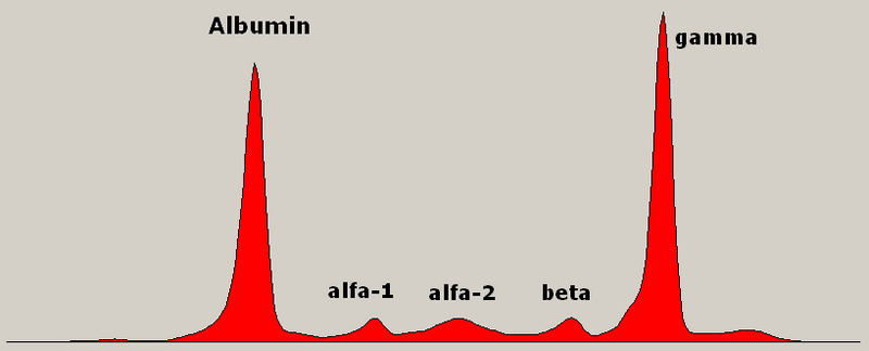 File:Monoclonal gammopathy Multiple Myeloma.png