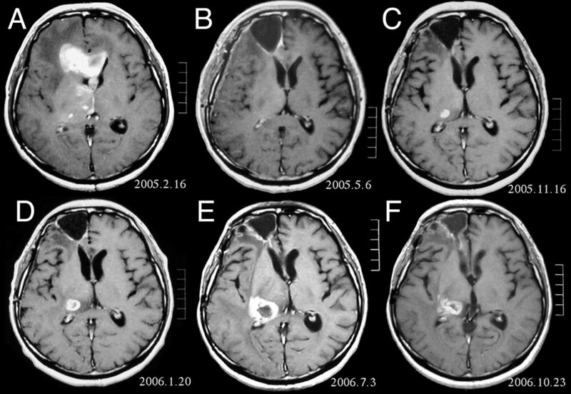 File:Anaplastic astrocytoma.jpg