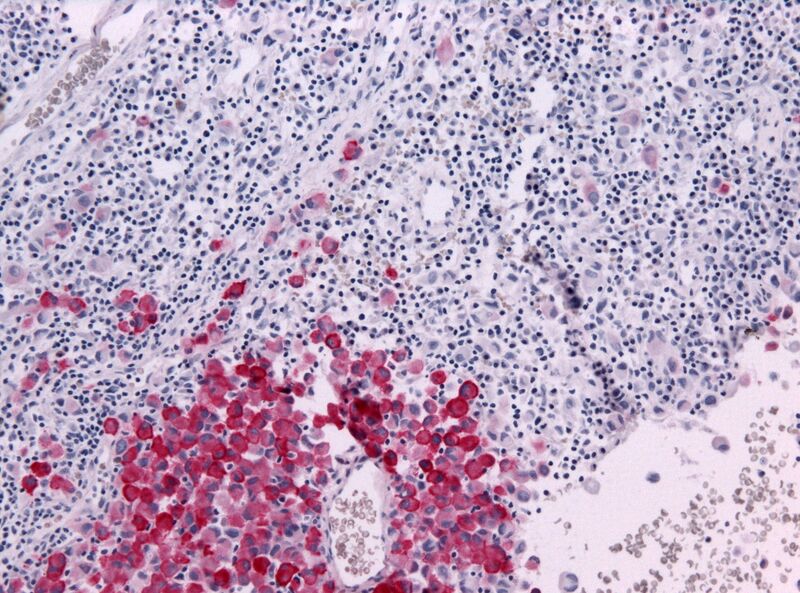 File:Malignant melanoma HMB45.jpg