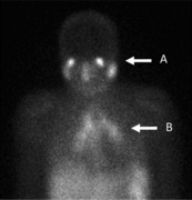 Gallium scan showing panda (A) and lambda (B) patterns