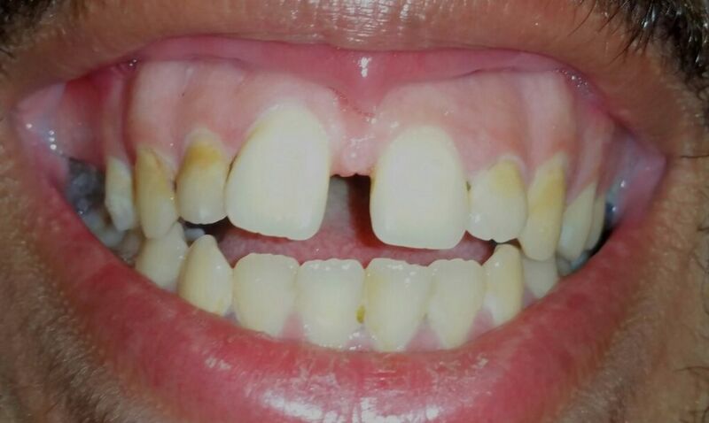 File:Anterior open bite.jpg