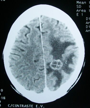 File:CT brain tumor.jpg