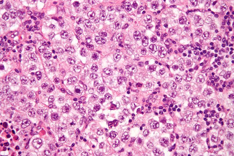 File:Seminoma high mag.jpg