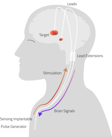 File:Adaptive Deep Brain Stimulation.png
