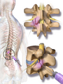 Illustration of a facet joint injection