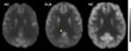 Dementia with Lewy bodies