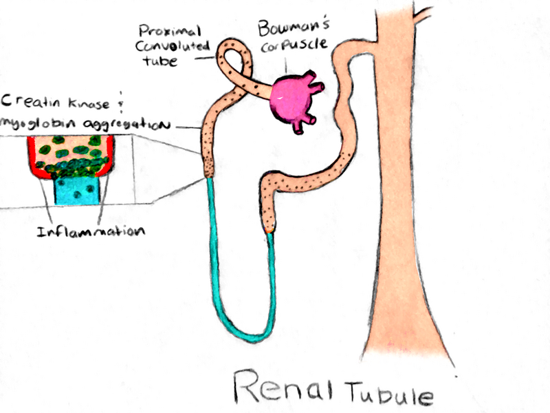 File:Renal Tubules of Exertional Rhabdomyolysis.png