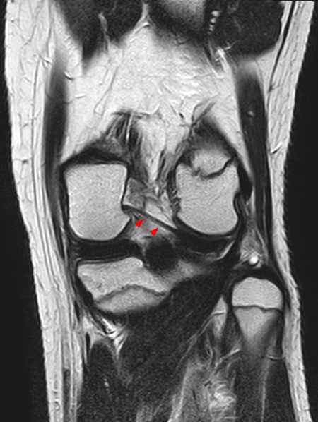 File:Ligamentum wrisberg.png