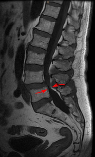 File:LumbarSpinalStenosis case1 2 7.svg
