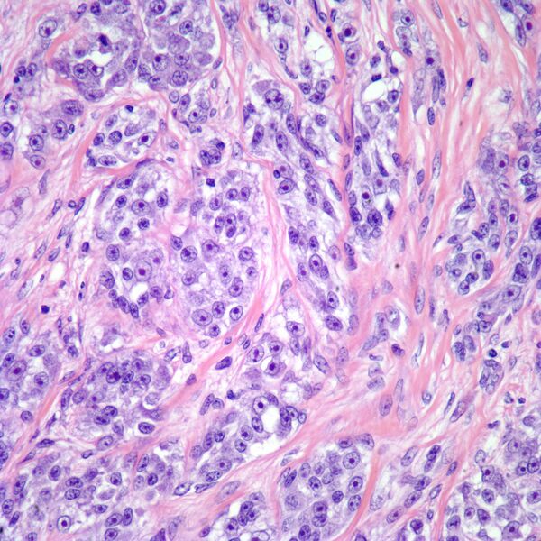 File:Clear cell sarcoma.Image12.jpg