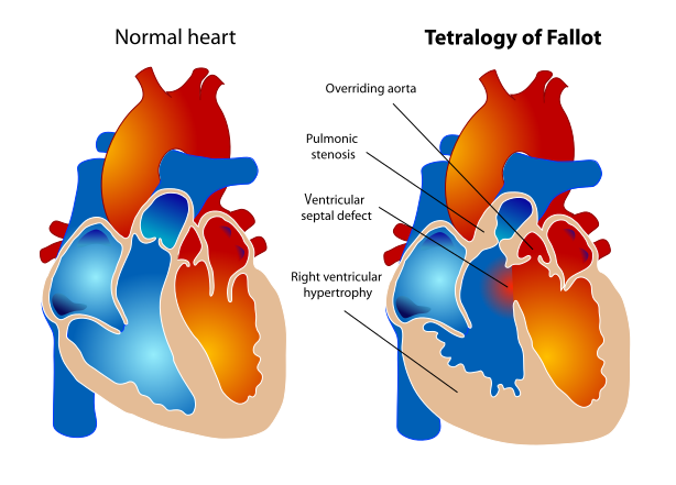 File:Tetralogy of Fallot.svg