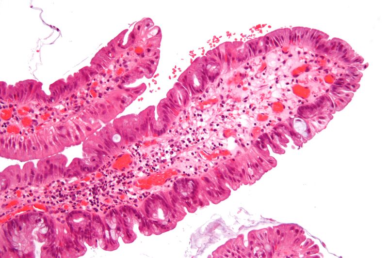 File:Traditional serrated adenoma intermed mag.jpg