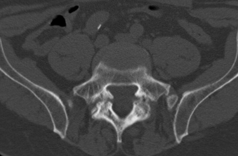 File:01-Spondylolyse L5S1 CT axial 001.jpg