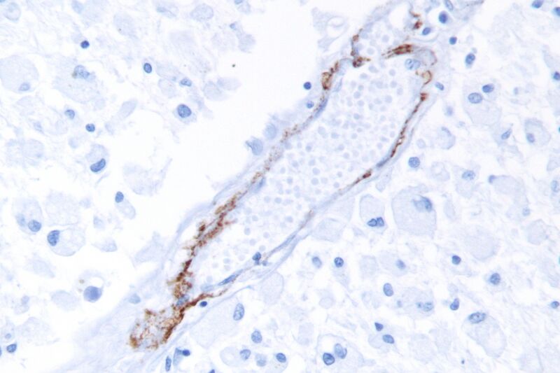 File:CADASIL - very high mag.jpg