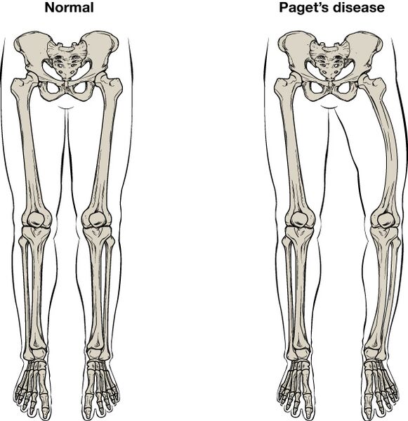File:610 Feature Pagets Disease.jpg