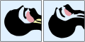 Basic airway management