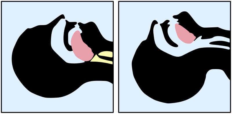 File:Tongue blocking airway.svg