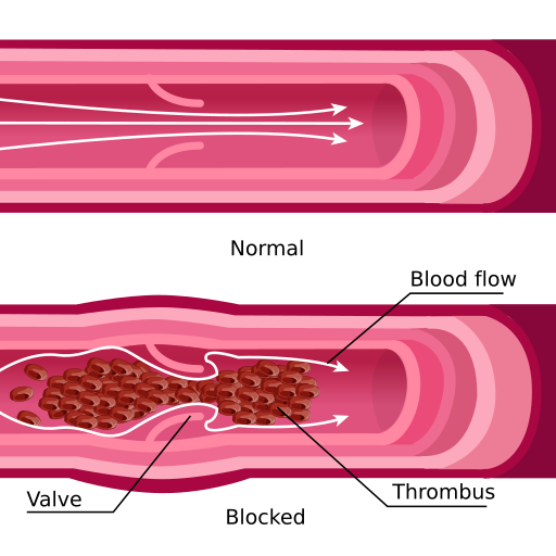 File:Blood clot svg hariadhi.svg