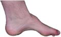 Charcot-marie-tooth foot