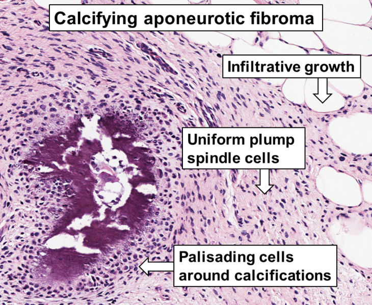 File:Histopathology of calcifying aponeurotic fibroma.png
