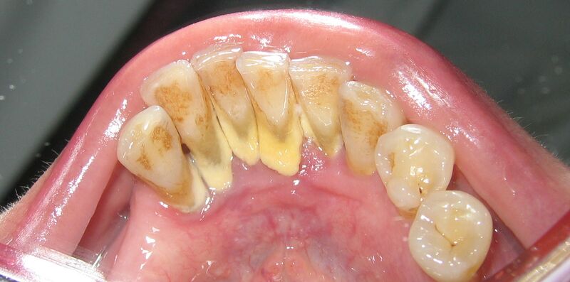 File:MandibularAnteriorCalculus.JPG