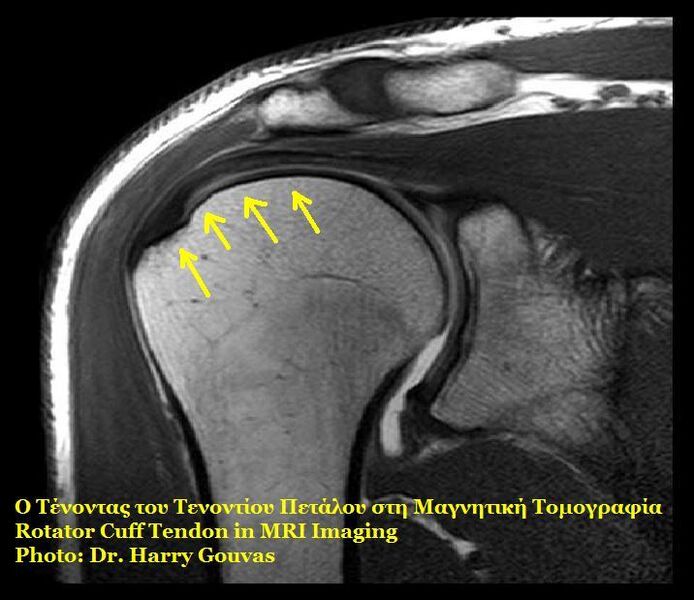 File:Rotator cuff.jpg