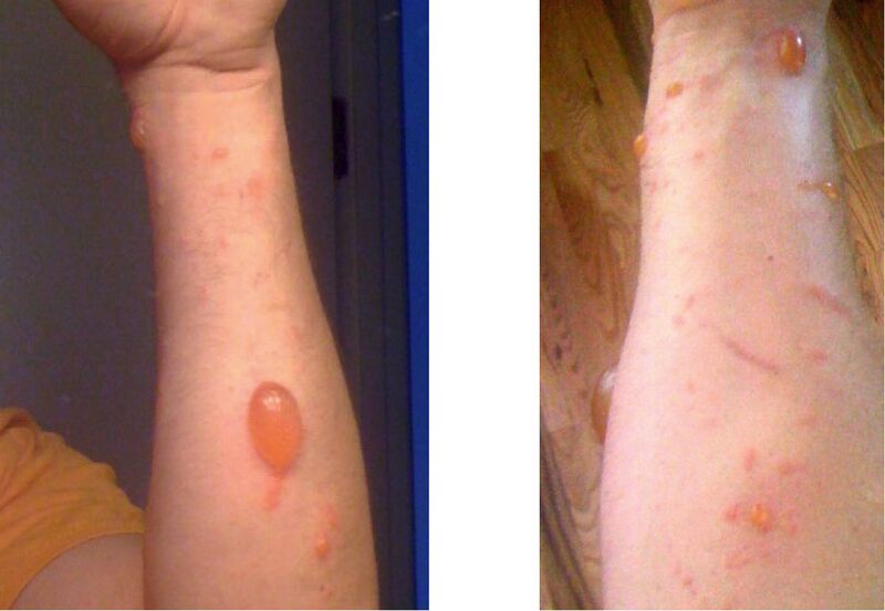 File:Urushiol induced contact dermatitis.jpg