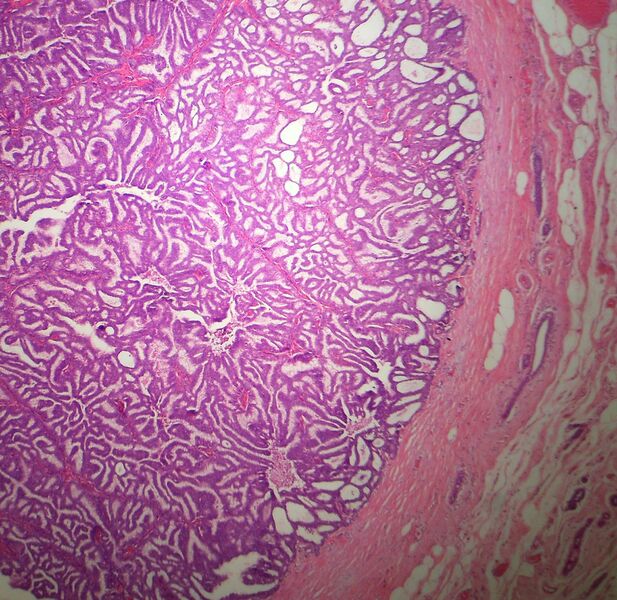File:Breast DCIS PapillaryVariant LP PA.JPG