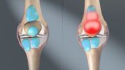 3 D image showing normal and bursitis