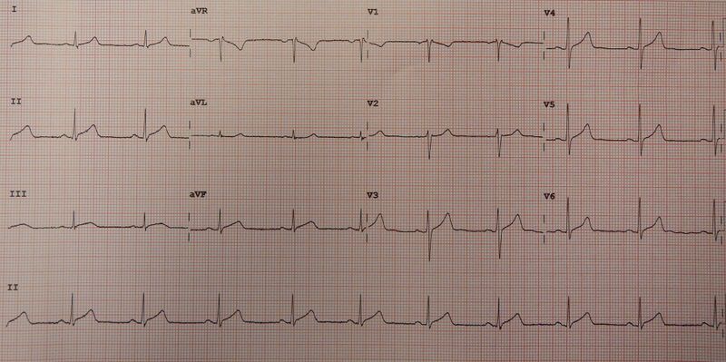 File:Acute pericarditis.jpg