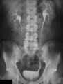Pyelogram