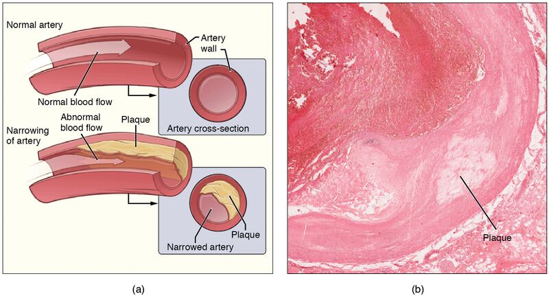 File:2113ab Atherosclerosis.jpg
