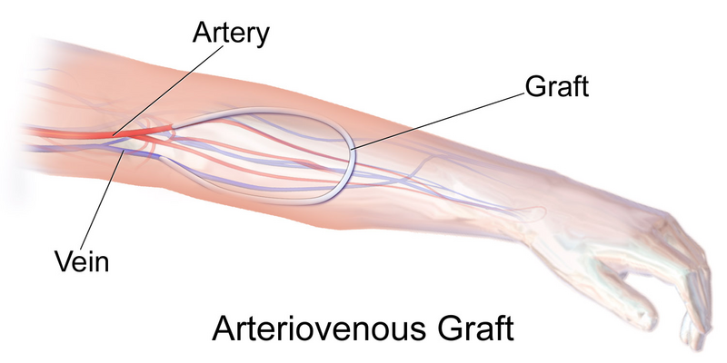 File:Blausen 0050 ArteriovenousGraft.png