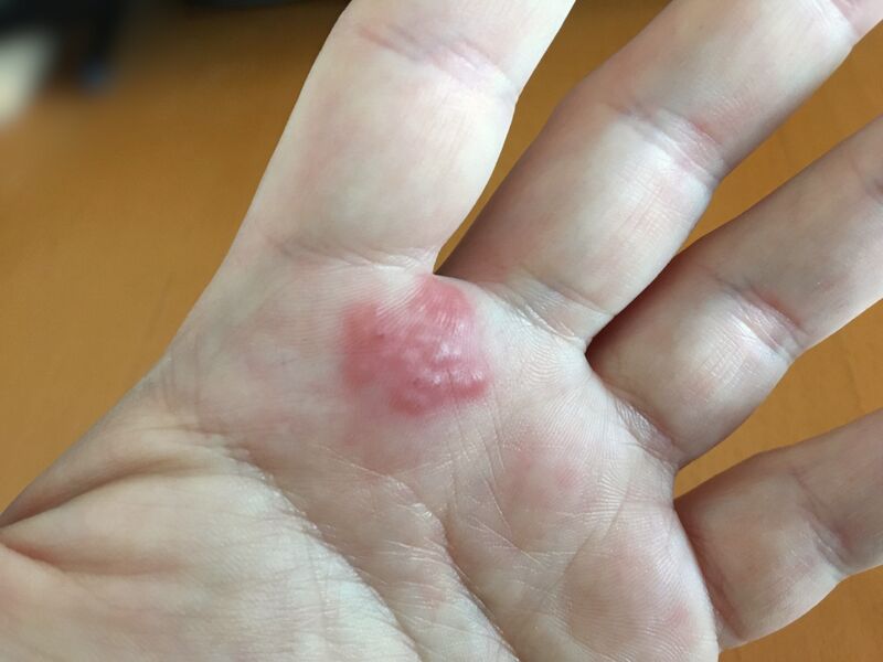 File:Contact dermatitis.jpg