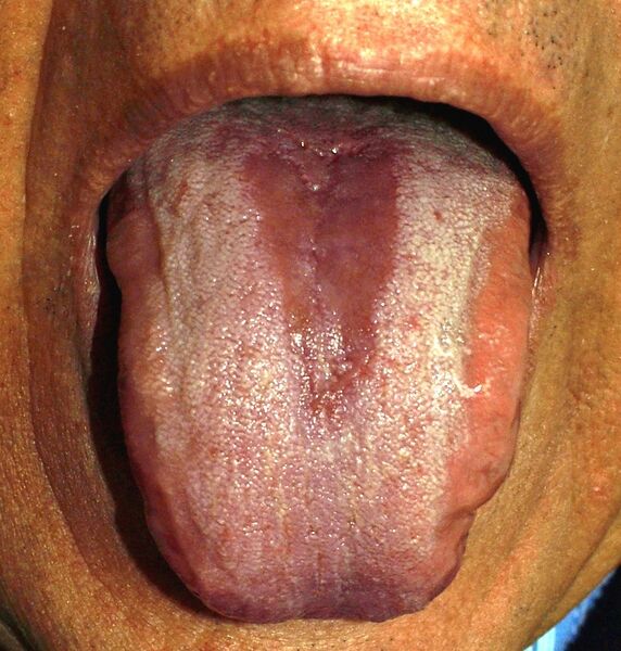File:Glossitis.jpg