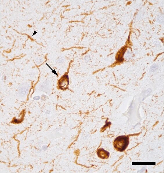 File:Tauopathy in Alzheimer's disease.jpg