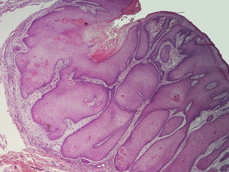 File:SkinTumors-P8190634.JPG