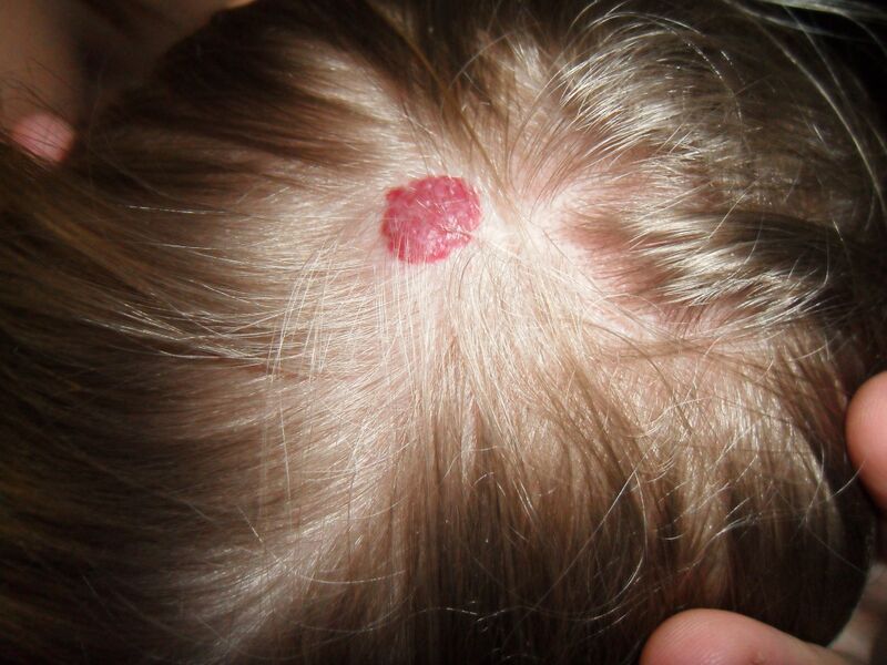 File:Hemangioma.JPG